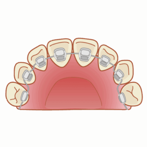 リンガルブラケット