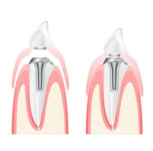 部分入れ歯(マグネットデンチャー)