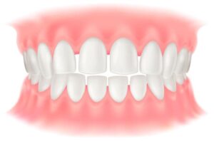 すきっ歯(空隙歯列:くうげきしれつ)