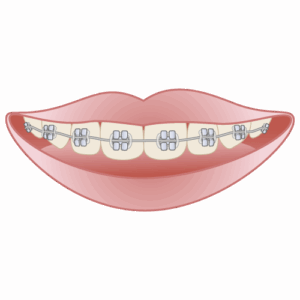 マルチブラケット