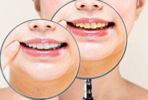 ホワイトニングのBefore After を見せる女性